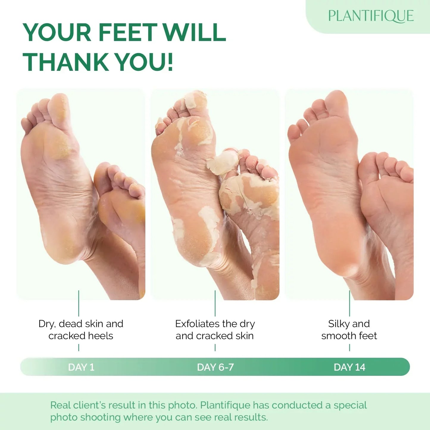 SeoulSkin Glycolic Acid Foot Peeling Mask (1 Pair), Korean Peeling & Exfoliating | Deep Exfoliation with Glycolic Acid, Removes Dead Skin, Cruelty-Free, Foot Peel Off Mask